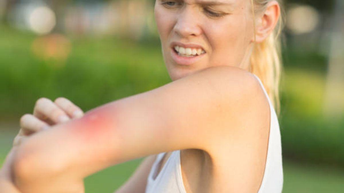 El truco del gel para evitar las picaduras de mosquitos.