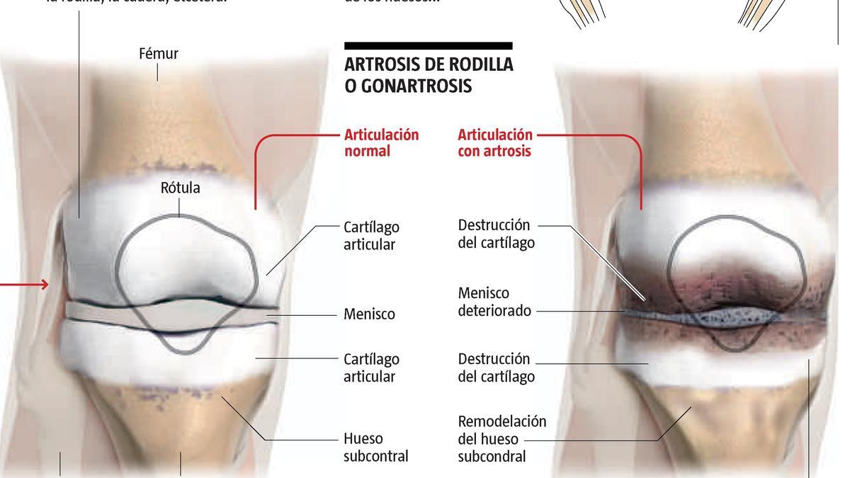 Así es la patología