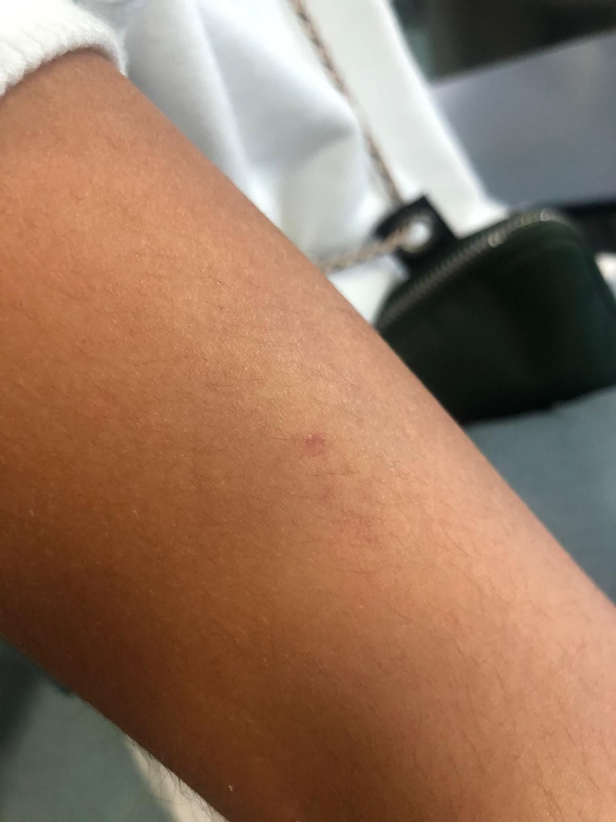 Marca dejada en el brazo de la víctima por un posible pinchazo en las fiestas de La Guancha.