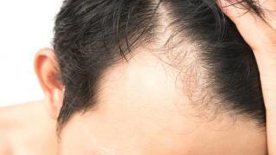 Alopecia Centro Dermatológico