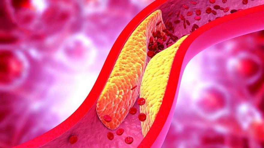 El colesterol alto se adhiere más con el desarrollo de la pandemia