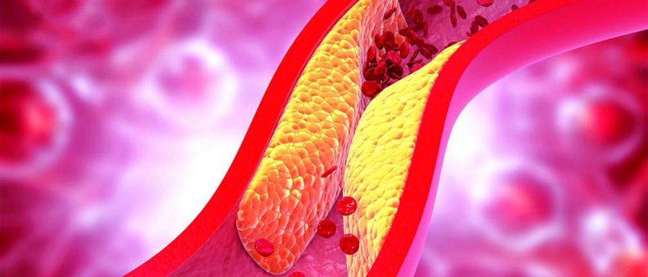 Representación del colesterol obstruyendo una arteria.   | | LP/DLP