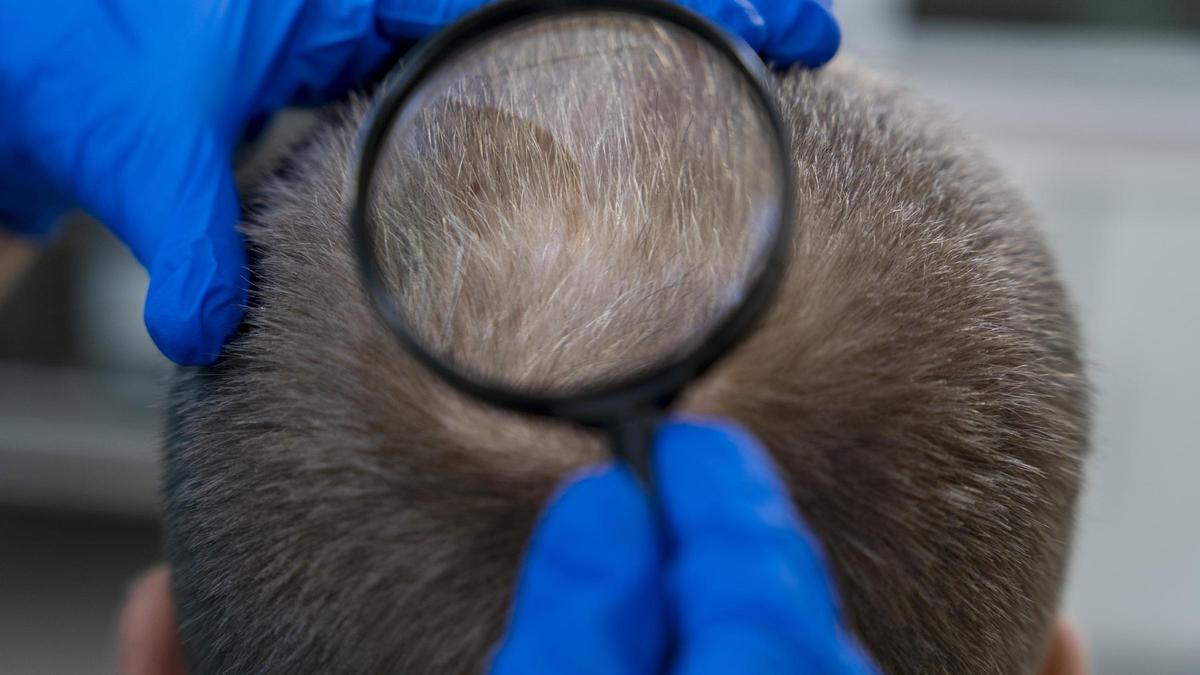 El 42,6 % de los españoles padece alopecia.