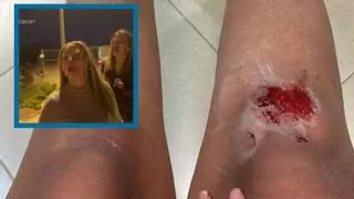 Agresión xenófoba en Alicante: estas son las lesiones que la joven agredida muestra en sus redes