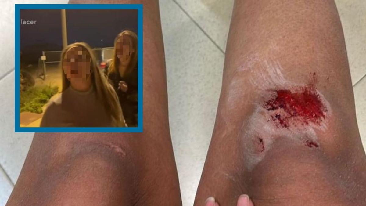 Estas son las lesiones que la joven agredida en Rojales muestra en sus redes