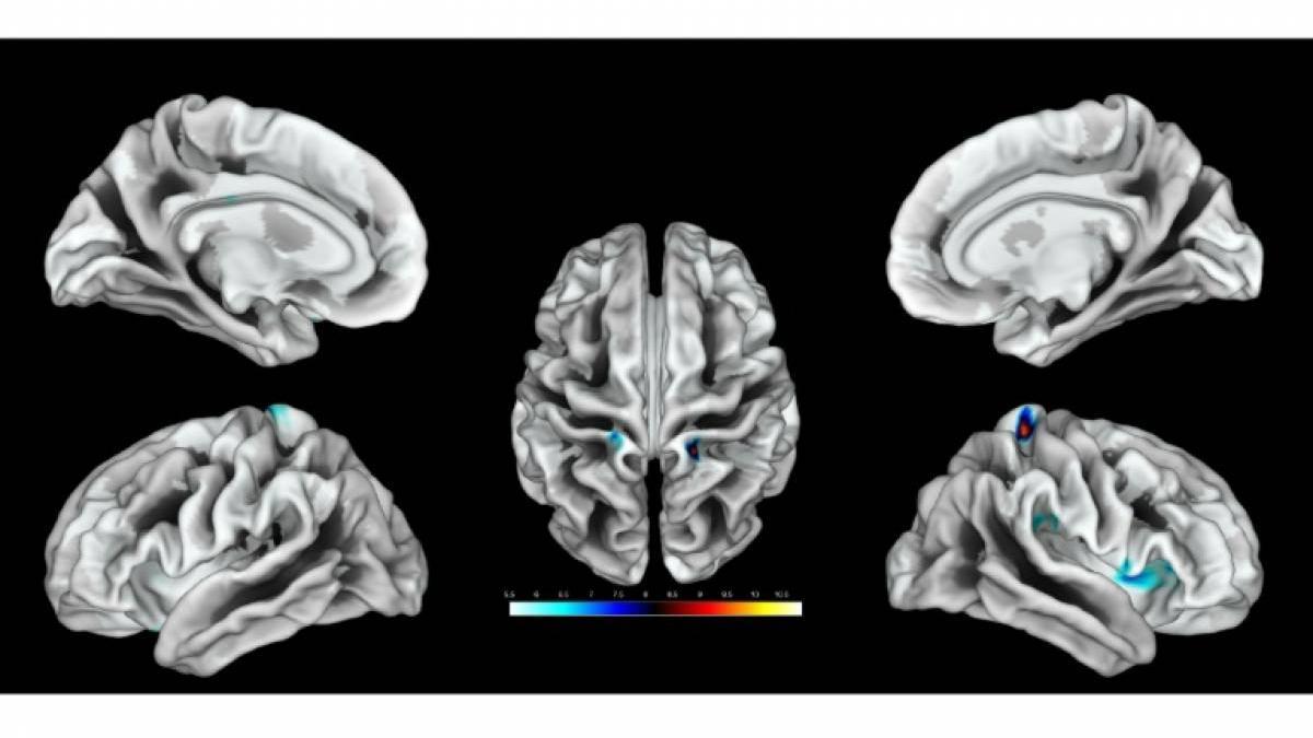 Ubicación de la región del cerebro activada por estimulación del clítoris en un grupo de mujeres.