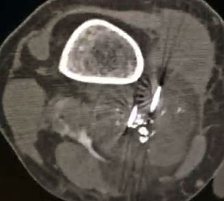 En esta imagen del TAC se aprecia el fémur, con reborde blanco, e inmediatamente debajo el tumor musculoesquelético con puntos blancos de las sondas.