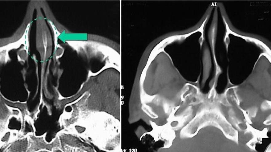 Dismorfia septal carti?lago (izq.) y dismorfia septal osea (dcha.).