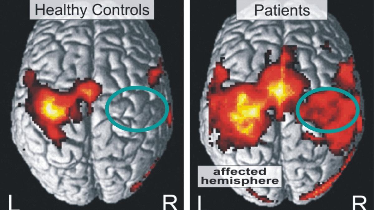 Activación cortical en sujetos sanos y pacientes con accidente cerebrovascular