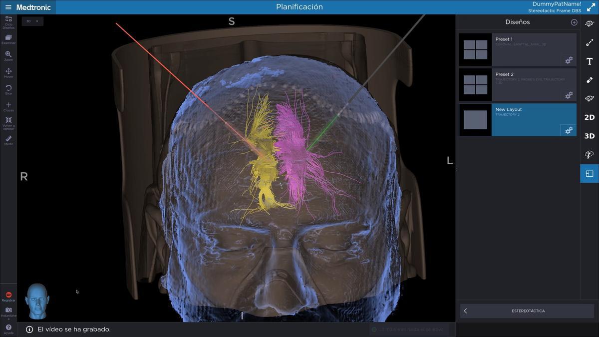 Planificación de la cirugía para tratar el dolor neuropático con estimulación cerebral profunda.