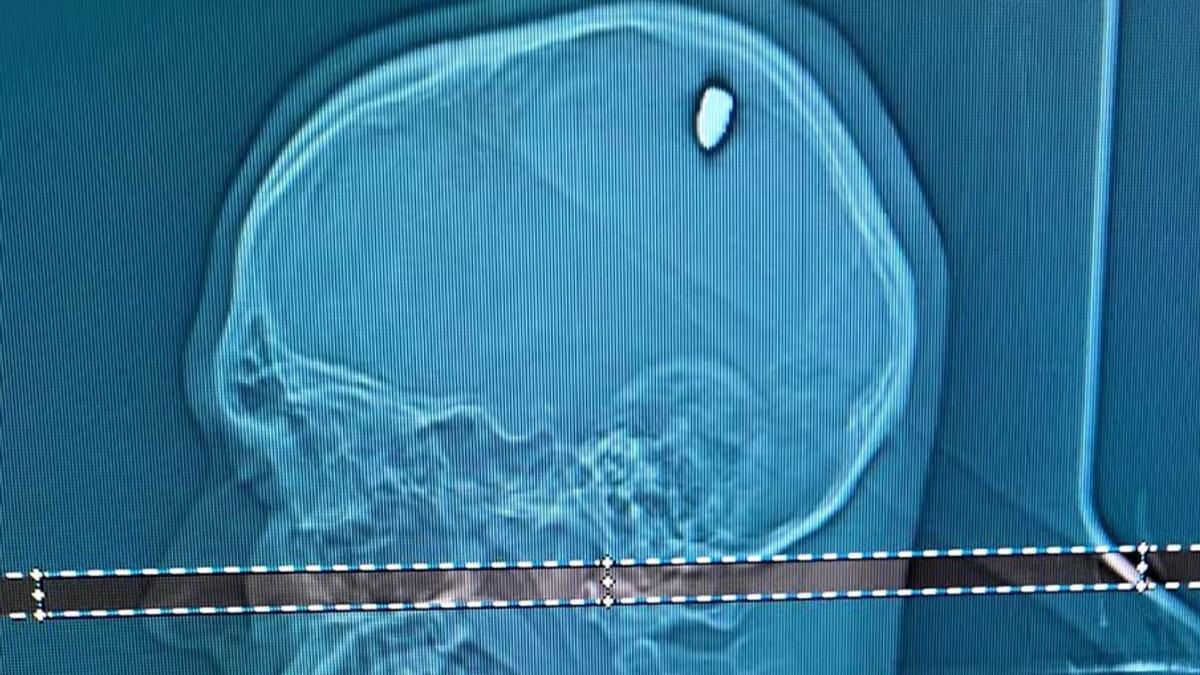 Un joven acude al médico por un dolor en la cabeza y descubre que tiene ...