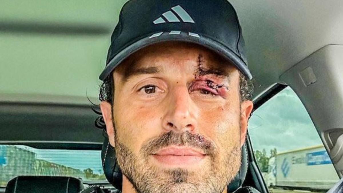 Fabio Grosso muestra los efectos de la agresión de los ultras