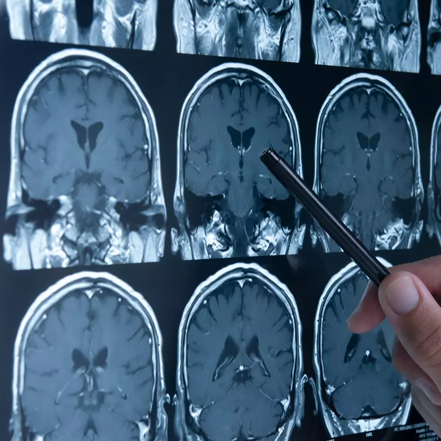 ¿Qué es el “código ictus" y por qué es tan importante?