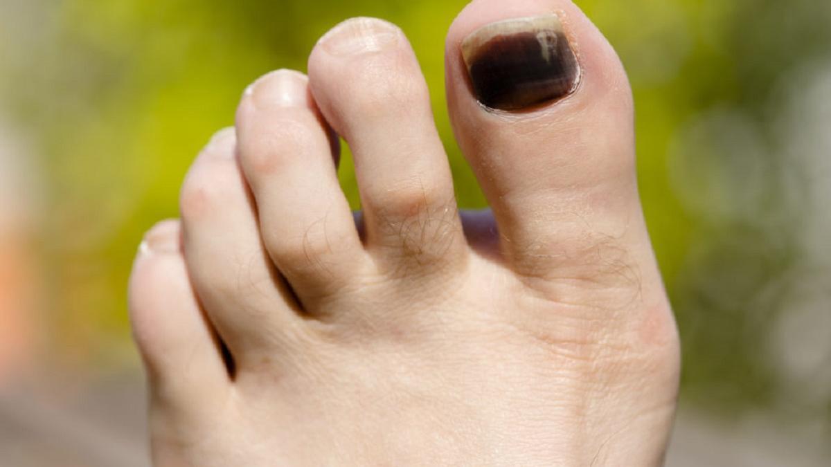 Uñas de los pies negras ¿me debo preocupar?