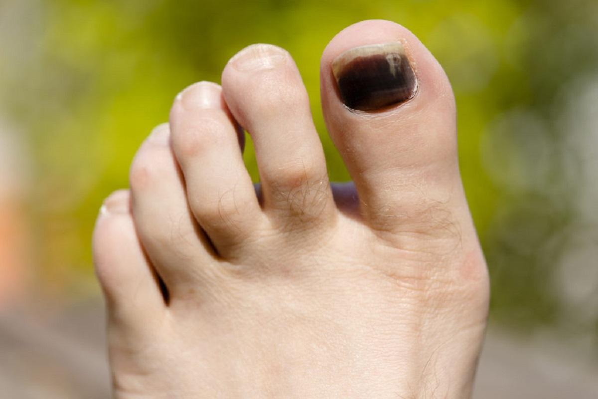 Uñas de los pies negras ¿me debo preocupar?