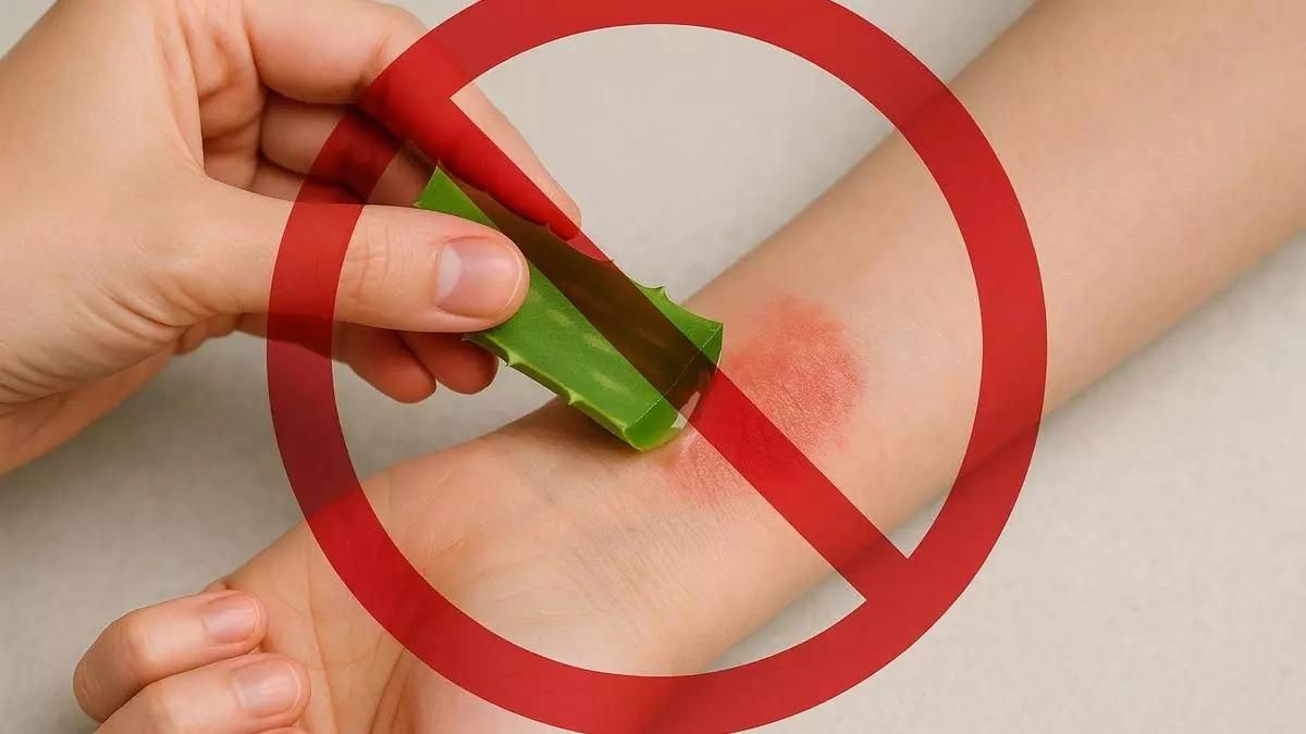 Boticaria García recomienda no aplicar aloe vera sobre las quemaduras