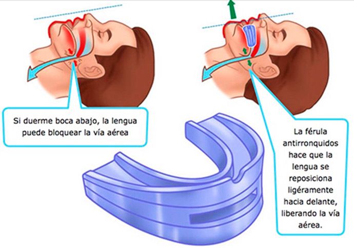 ¿Roncas? Di adiós a la apnea del sueño y a los ronquidos