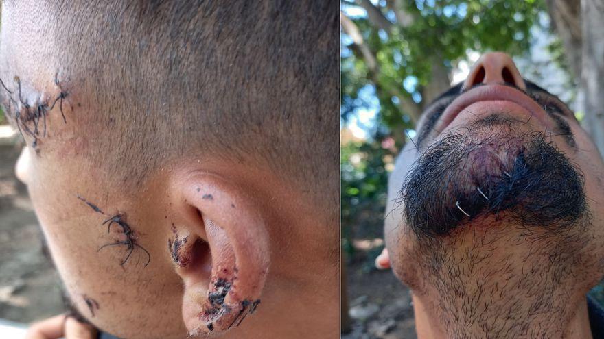 Un inmigrante marroquí escondido en Ceuta muestra las lesiones que ha recibido al ser atracado por otro migrante este pasado lunes.
