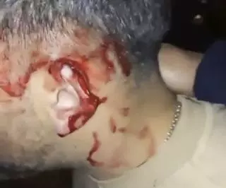 Arrancan la oreja de un mordisco a un hombre durante una pelea en Tui