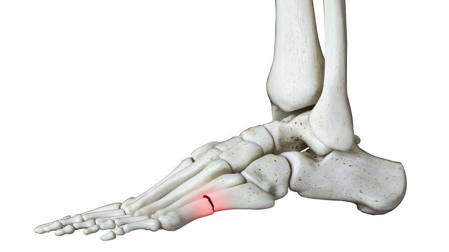 ¿Cómo ataca el estrés a los pies? Así se previene y se trata &quot;la fractura del recluta&quot;