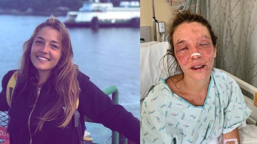 La joven de Terrassa que se quemó la cara con sosa caústica recauda 200.000 euros para su tratamiento