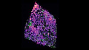 Tumor de glioma humano con una mutación que muestra grupos de células T en verde y cuyos puntos rosa representan concentraciones del metabolito D-2HG.