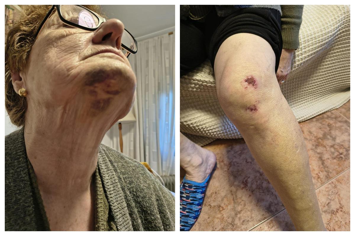 Imágenes de las lesiones sufridas por una persona mayor en el parque