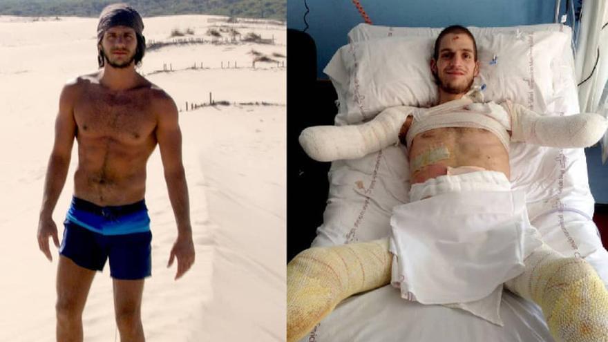 Davide, antes y después de la meningitis // Davide Morana