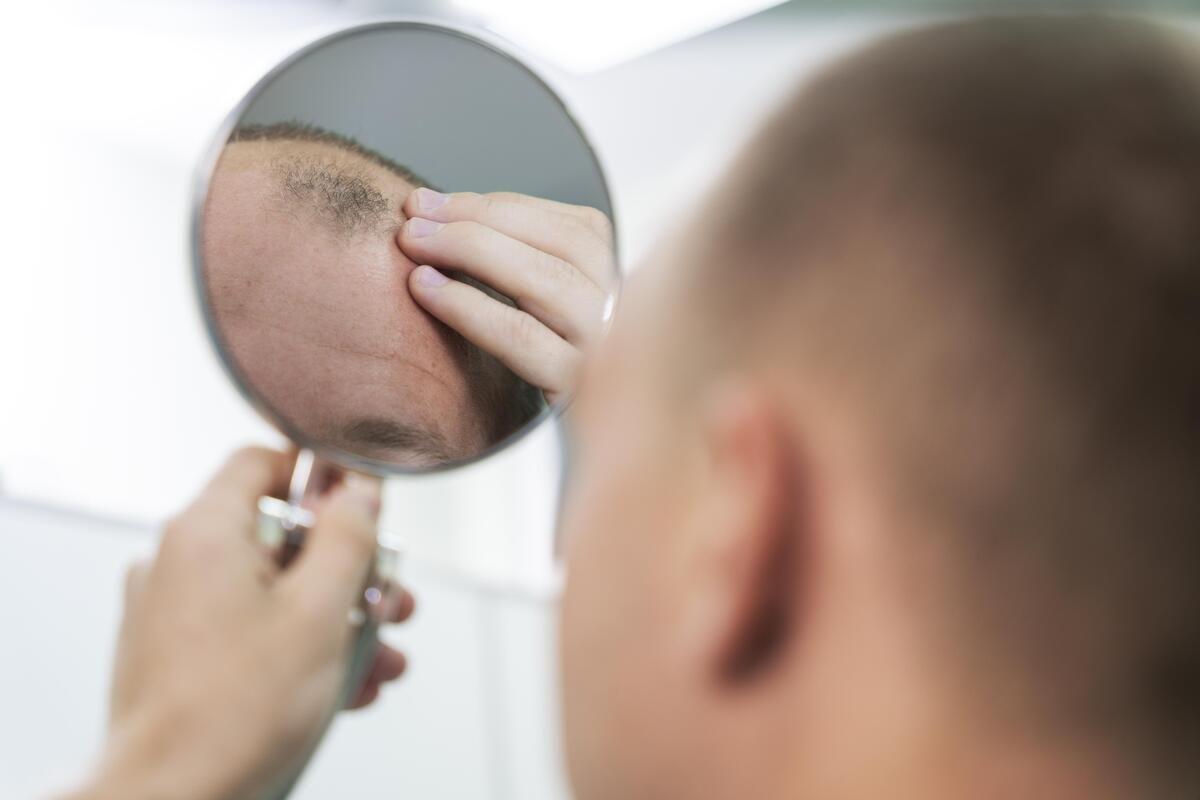 Olumiant: Así es el primer fármaco aprobado contra la alopecia areata