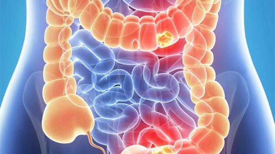 Un diagnóstico precoz del cáncer de colon supone un 80% de posibilidades de curación