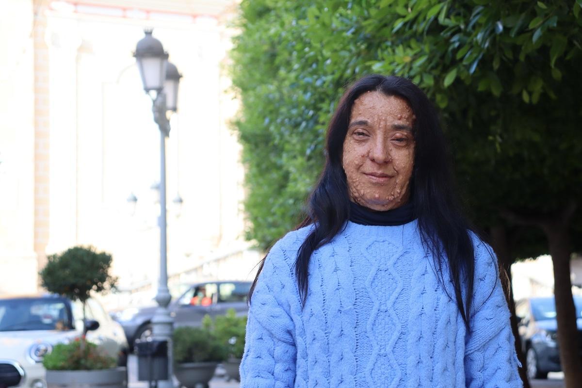 Marga, paciente de NF1, convive con el dolor de los fibromas y del rechazo social.
