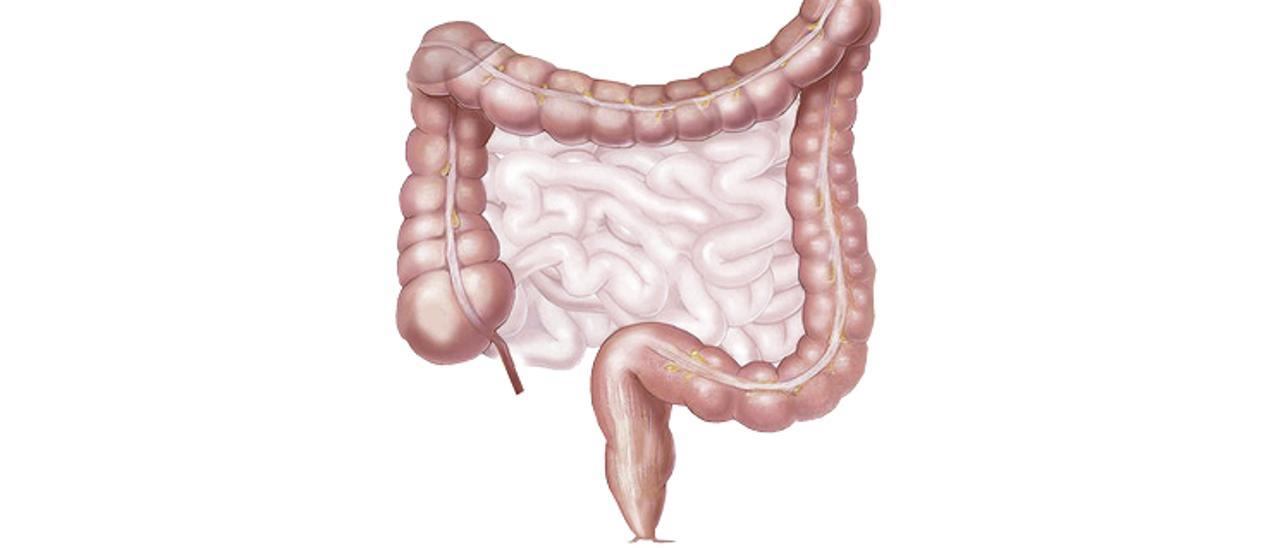 Inflamaciones intestinales, enfermedades del estilo de vida occidental - La  Nueva España