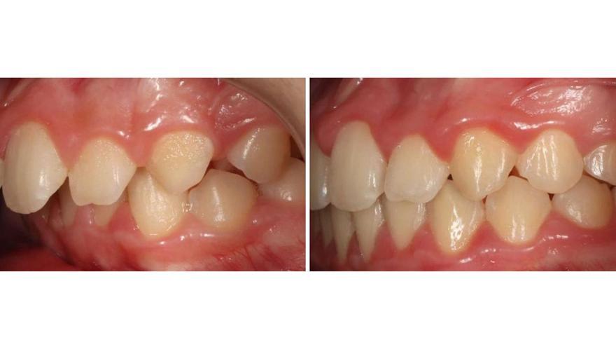 Repercussions d’una malposició dental
