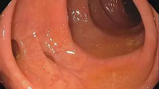 Divertículos en el colon: Qué son, cómo prevenirlos, sus síntomas y opciones de tratamiento