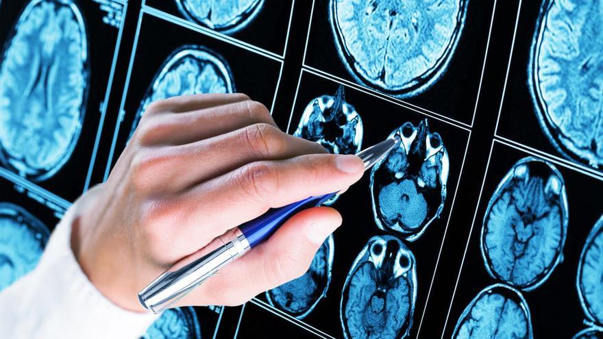 La epilepsia está provocada por una actividad eléctrica anormal en el cerebro.