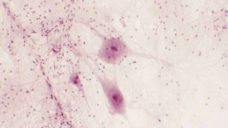 Vista de una célula afectada con esclerosis lateral amiotrófica