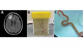 Encontrado un parásito gusano vivo de ocho centímetros en el cerebro de una mujer