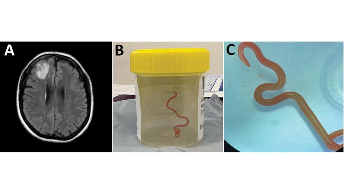 Una neurocirujana extrae un gusano de 8 centímetros del cerebro de una paciente en Australia