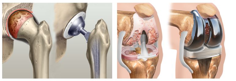 En las fotografías de arriba se puede observar el estado de una cadera y una rodilla con artrosis, a la izquierda de cada imagen, y tras la implantación de una prótesis total, a la derecha.
