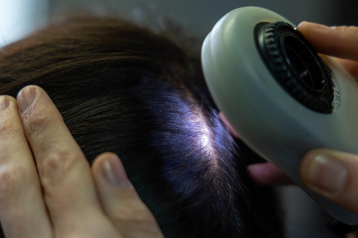 Una de cada cuatro jóvenes sufre excesiva caída del cabello y los peinados tirantes son una de las causas n Una de cada cuatro jóvenes sufre excesiva caída del cabello y los peinados tirantes son una de las causas n