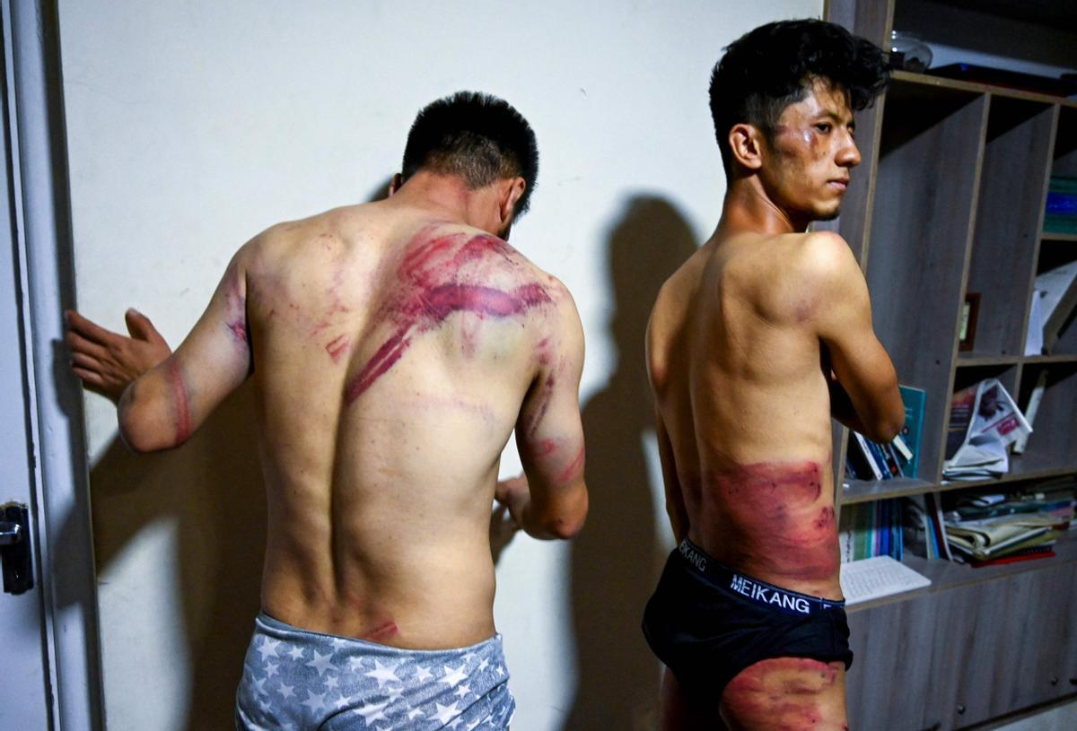 Los periodistas agredidos muestran las heridas que les han dejado los talibanes.