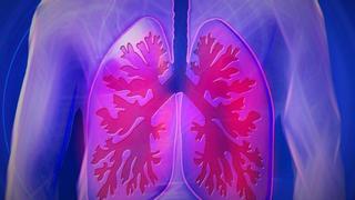 ¿Qué son las enfermedades pulmonares intersticiales difusas?