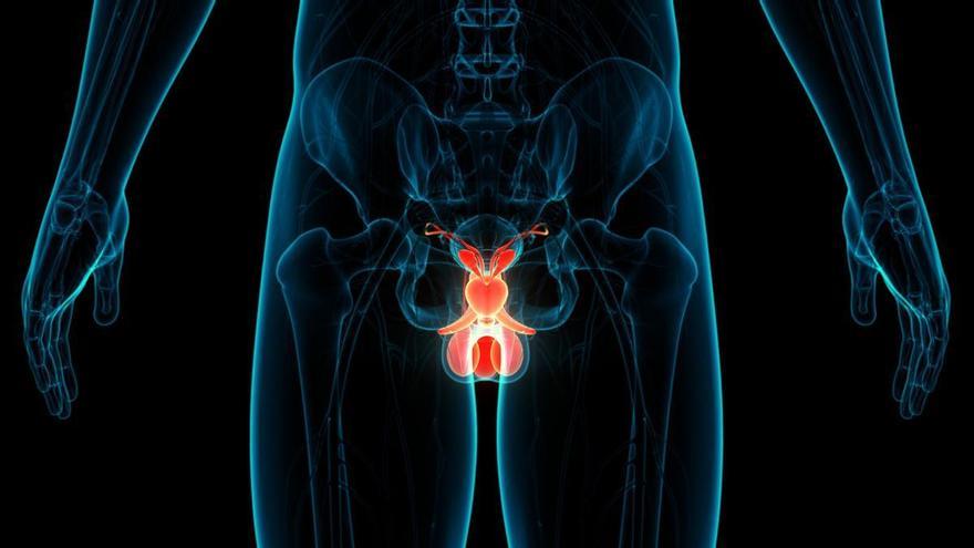 Descobreixen un mecanisme per atacar els càncers de pròstata resistents als tractaments