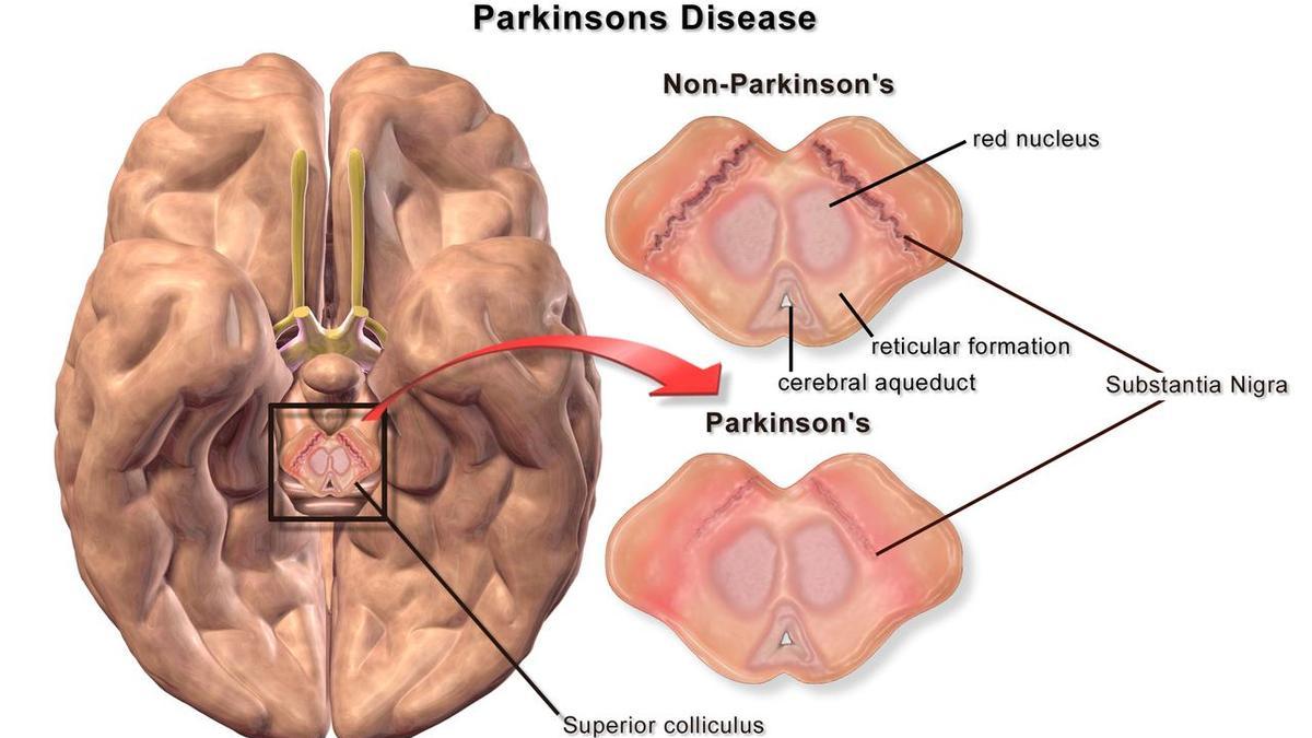 Así se puede onservar la enfermedad de Parkinson&#039;s