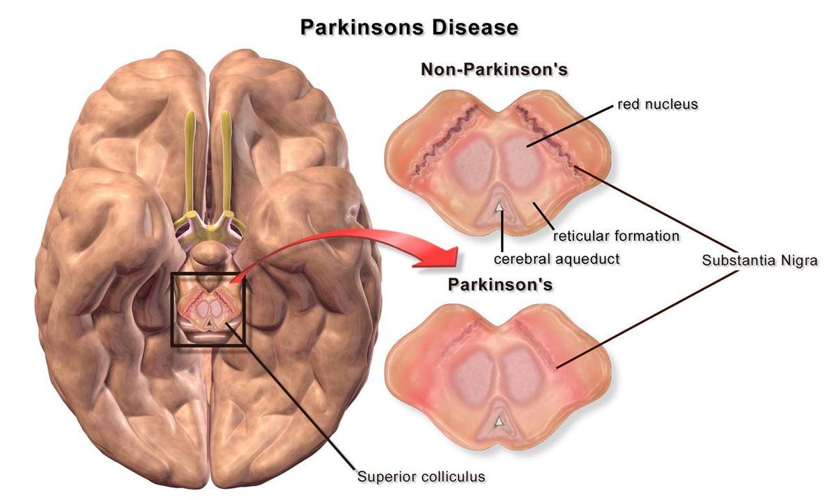 Así se puede onservar la enfermedad de Parkinson's