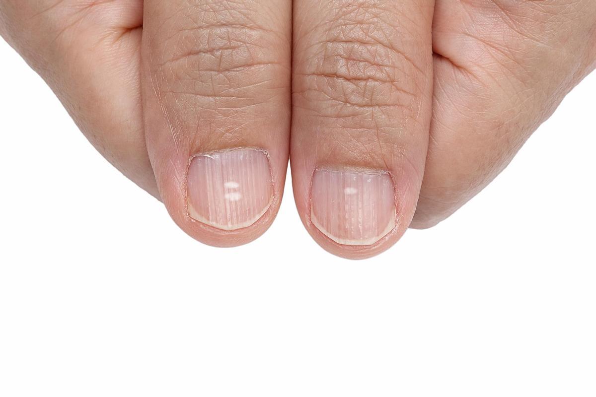 Significado de las manchas blancas en las uñas.