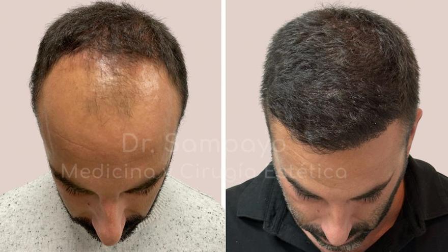 Sampayo: &quot;Analizamos los 13 genes y 48 variaciones  relacionados con la alopecia para realizar una microcirugía capilar definitiva&quot;