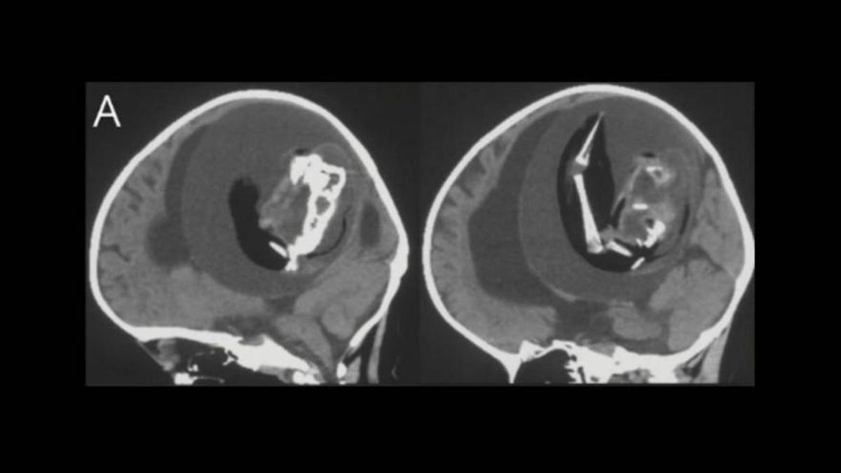 A les imatges cerebrals de la nena d'1 any, els científics van poder observar el fetus amb una columna vertebral i altres estructures òssies