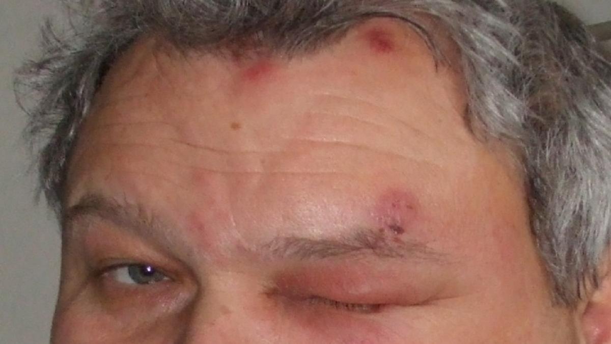Se estima que 1 de cada 3 personas de entre 50 y 90 años desarrollará un herpes zóster a lo largo de su vida.