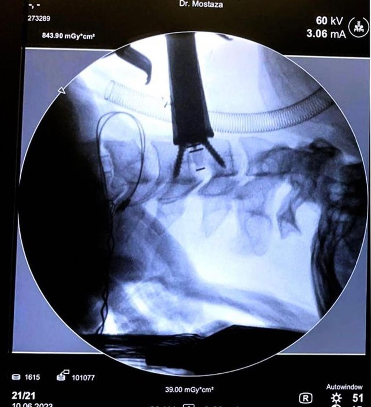 El equipo médico ha implantado una placa de titanio en la columna cervical del diestro